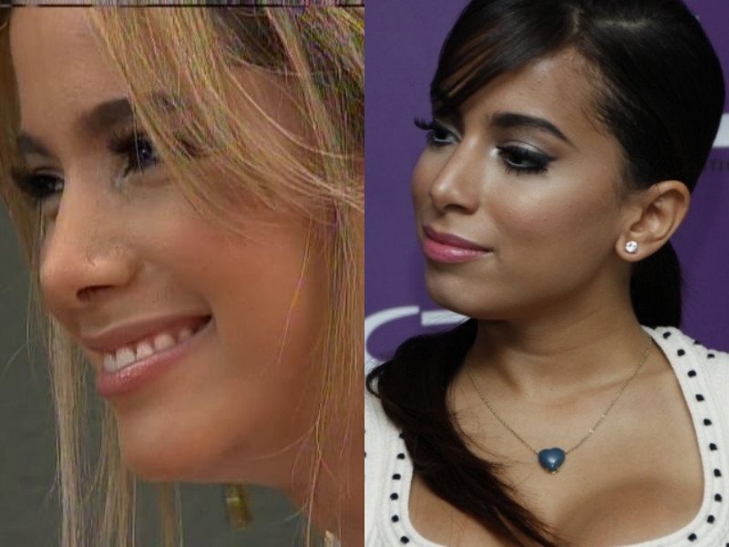 Anitta plástica nariz antes depois Anitta plástica nariz antes depois